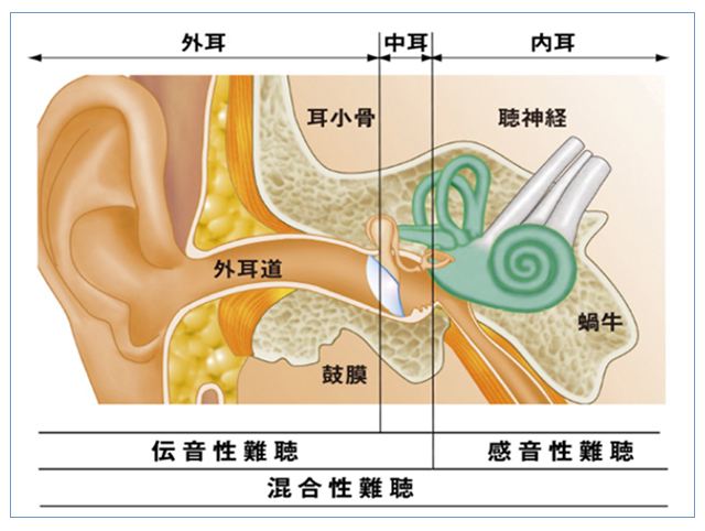 図:難聴の仕組み
